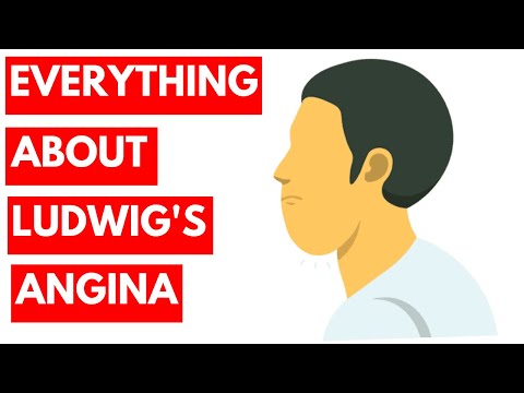 Ludwig&rsquo;s Angina -Introduction, Etiology, Clinical Features, Investigations, Treatment
