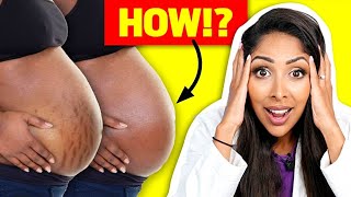 I Tested Stretch Mark Creams So You Dont Have To Doctor V Reveals All