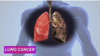 Formation of Lung Cancer | Lung Cancer Symptoms |