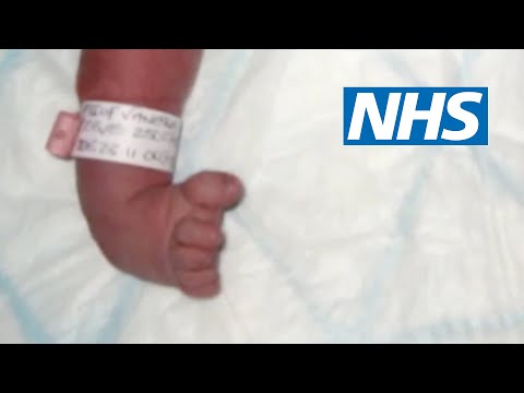 Club foot | NHS