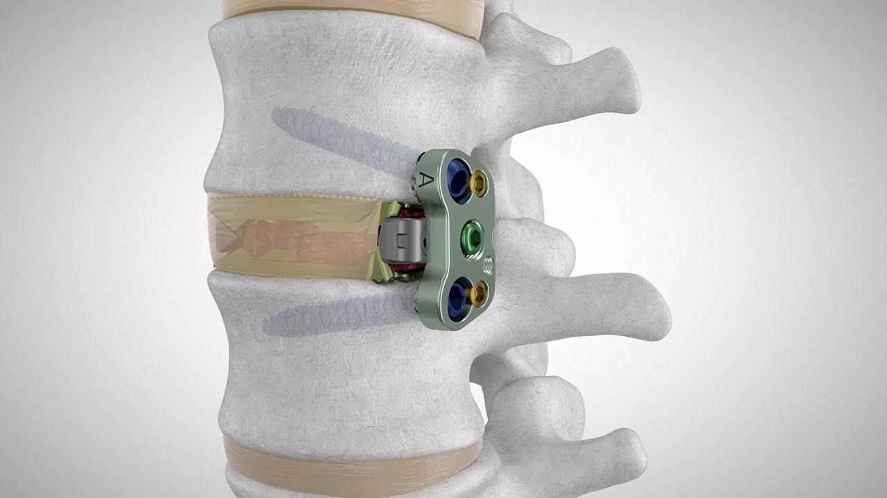 ADIRA™ XLIF™ Plate System | Globus Medical