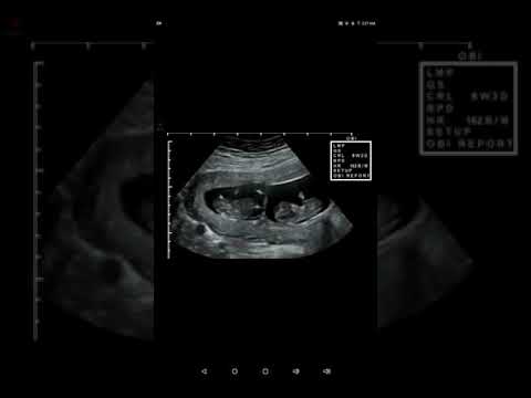 i-am-14-years-old.-and-pregnant-it-is-app-ultrasound