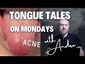 TONGUE TALES ON MONDAY: ACNE