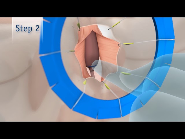 AdVance™ XP Male Sling System product animation