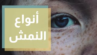 ما هي أسباب النمش على الوجه والجسم وكيفية علاجه