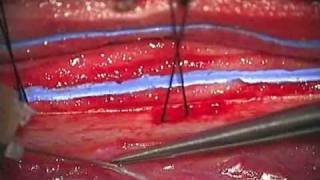 Icg Videoangiography