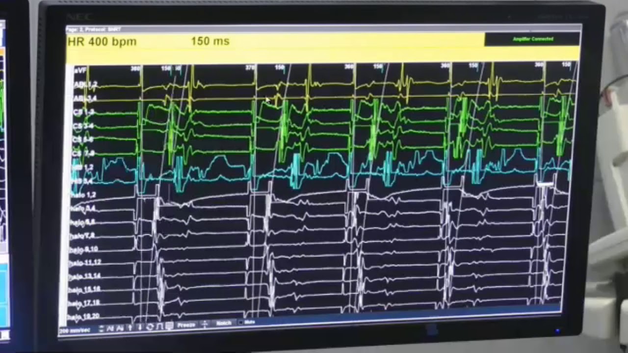Antero septal Accessory pathway
