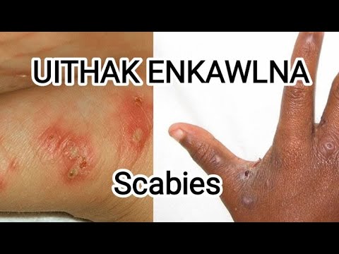 UITHAK SCABIES ENKAWLNA LEH INVENNA Gilead Thinghnai 