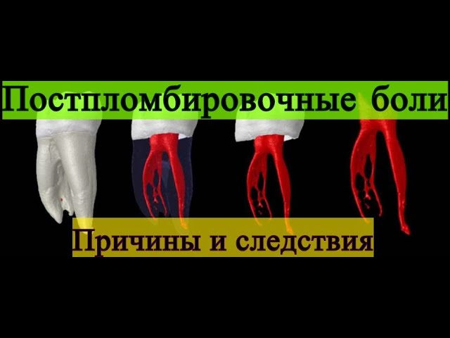 Почему болит зуб после пломбировки корневых каналов?