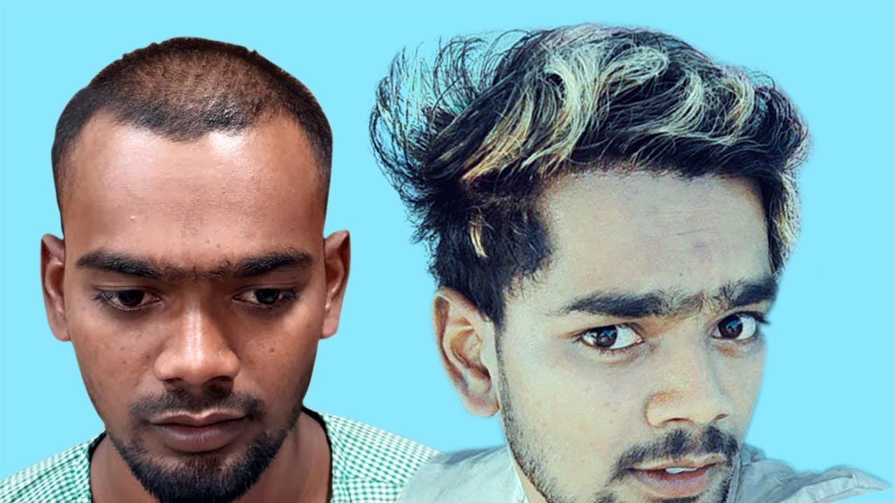 Can We Colour Hair After Hair Transplant ? | Hair Transplant Results Before And After |
