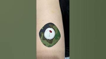 Hight blood sugar, a bleeder is a reader #diabetes #g7 #dexcom @marycomeau