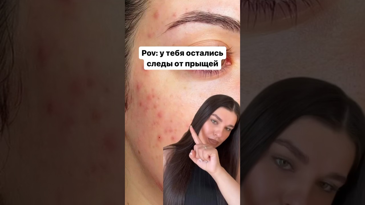 Витамин С ✅ #бьютисоветы #уходзакожей #витаминс #постакне