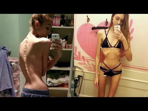 MY ANOREXIA STORY (GRAPHIC)