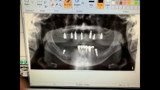 Highlights from Clinical Implantology A to Z 2019-2020 / WA AGD Dr. Alan Yassin screenshot 2