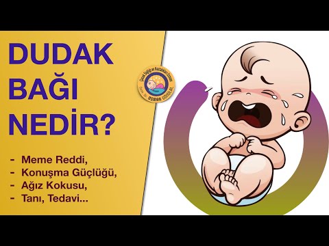 Bebeklerde Dudak Bağı (Meme Reddi, Tanı, Tedavi)