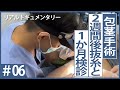【包茎手術】真性包茎治療のリアル映像!!２週間後の抜糸と１ヶ月後検診!!
