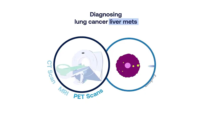 Lung Cancer Liver Metastasis: Symptoms, Diagnosis, and Treatment (2 min)