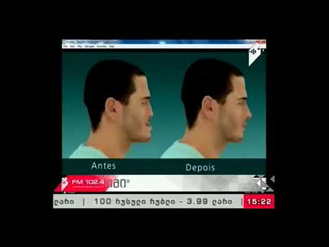 \"ოჯახის ექიმი\" 11.08.17 ყბა-სახის რეკონსტრუქციის უნიკალური ოპერაცია საქართველოში