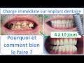 Dents fixes sur implant dentaire - Charge immédiate - Part 1