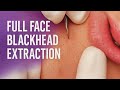 Full Face Blackhead Extraction — Every Pimple Popped Perfectly