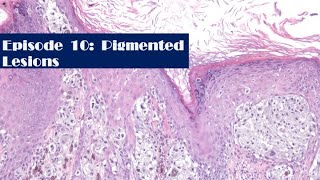 Episode 10: Pigmented lesions