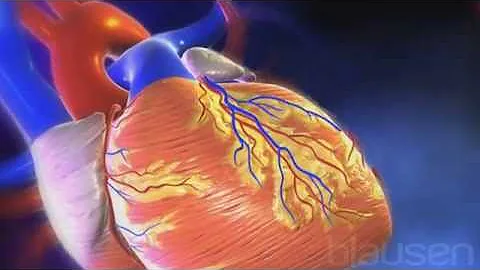 ¿Se ve el infarto en la resonancia?