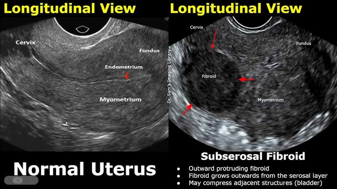 Fibroids Nice Cks fibroids-nice-cks