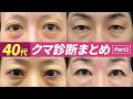 40代のクマ取り決定版:あなたのクマはどのタイプ?#目の下のクマ取り#美容整形#表ハムラ#整形#湘南美容クリニック