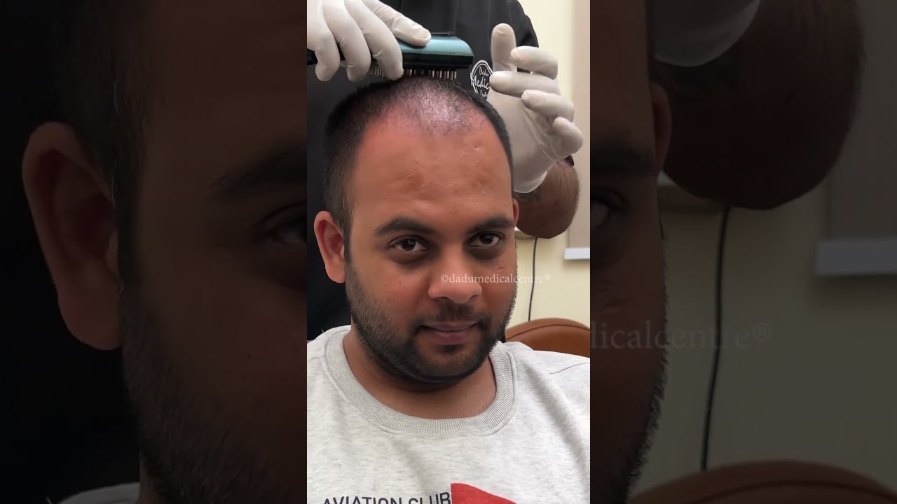 My Post Hair Transplant DMC HGP Session Dadu Medical Centre Trichology