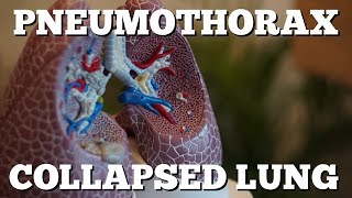 Pneumothorax Collapsed Lung: Types, Symptoms, Diagnosis, Treatment: Quick & EZ [Episode 10]
