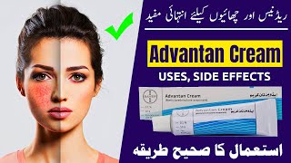 Advantan Cream: Uses, Benefits, and Side Effects Discussed
