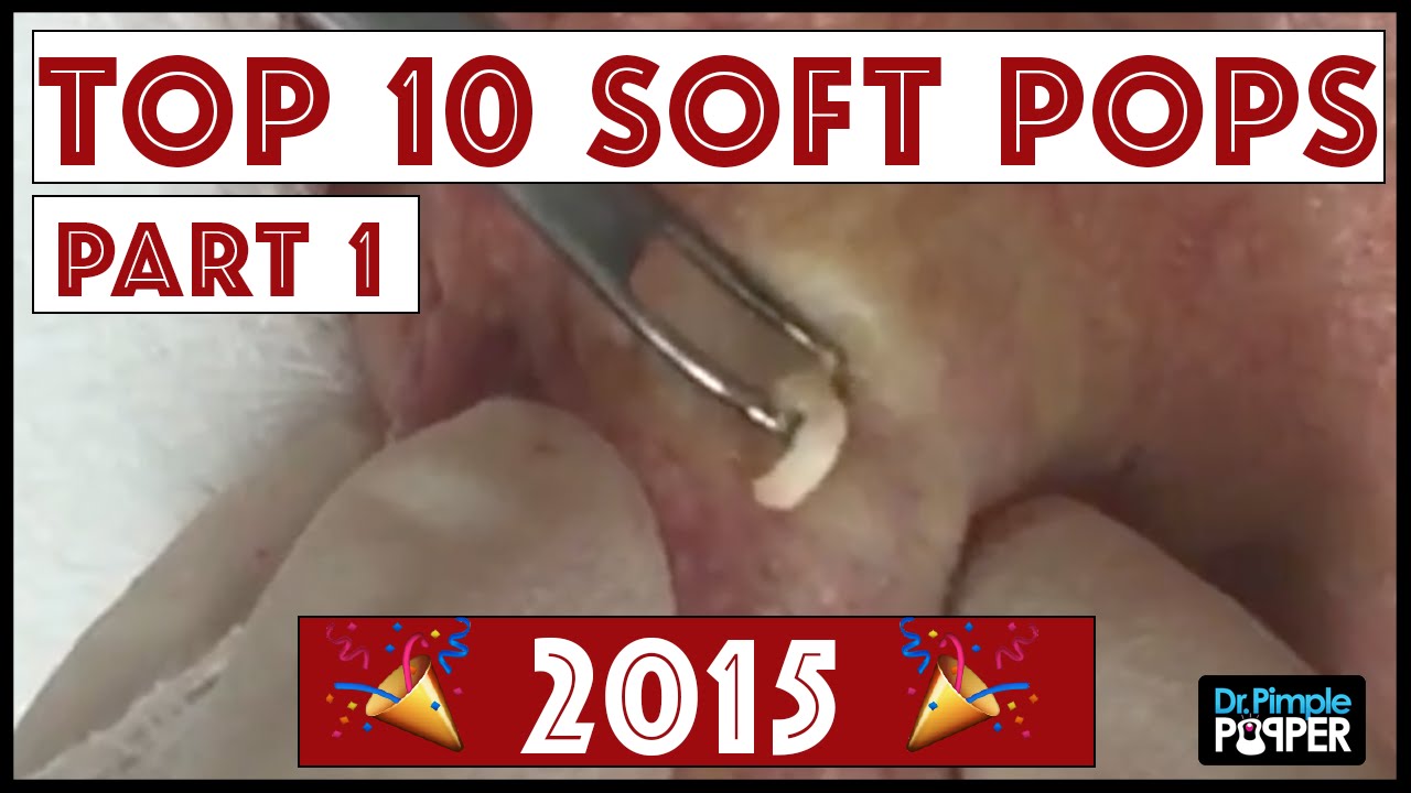 Faktisk Mundskyl Bidrag My Top 10 BEST Blackhead Pops of 2015: Part 1, #4-#10 - YouTube