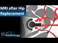 4 surgical approaches in Hip Arthroplasty on MRI