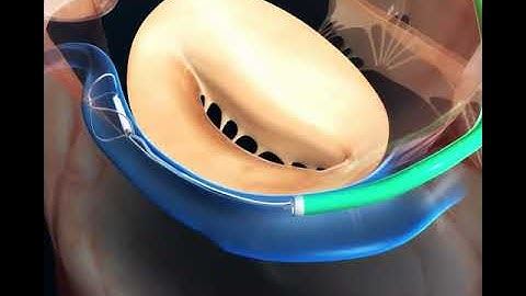 Carillon Cinching - Animation