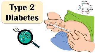 Type 2 Diabetes - Causes, Risk Factors, Signs & Symptoms, Treatment - Everything You Need To Know