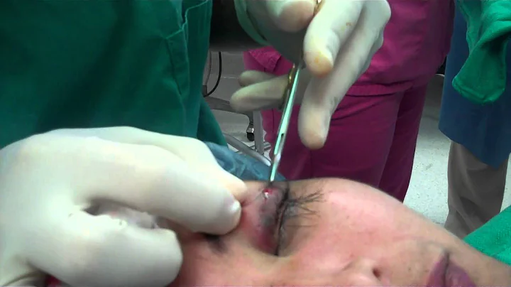 Dr. Jeffrey Epstein - Eyelash Transplant