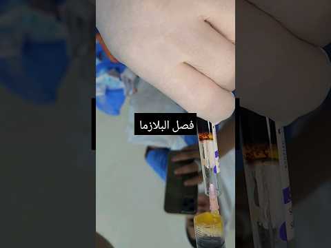 كيفيه فصل البلازما بلازما د محمد الشاعر عظام