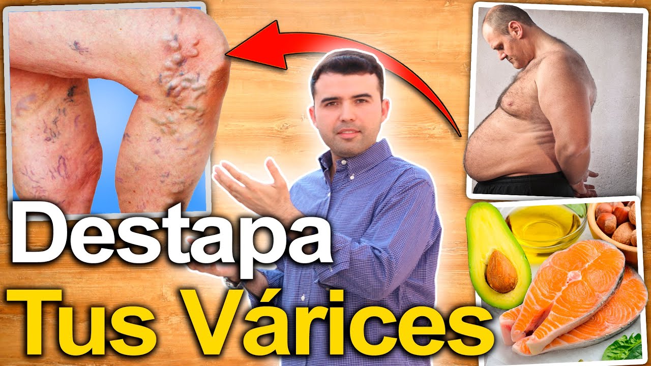 Se pueden eliminar las varices