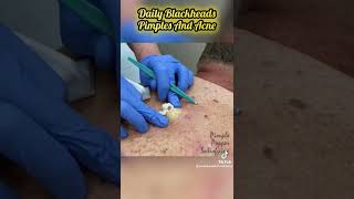 Blackhead Extraction From Back