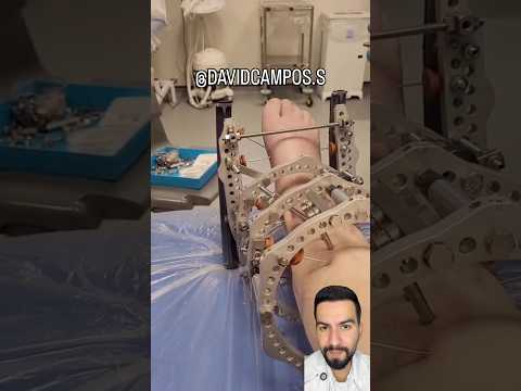 FIJADOR DE FRACTURA