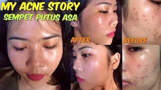 My Acne Story | Melawan Jerawat TANPA Cream Dokter