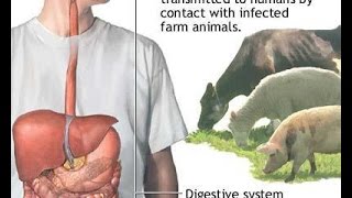 Brucellosis