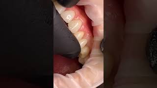 طربوش الأسنان (Dental crown)👑🦷🔥