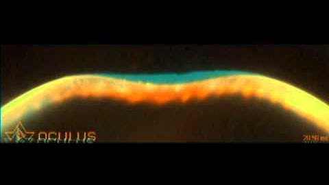 Scheimplfug Deformation Analysis