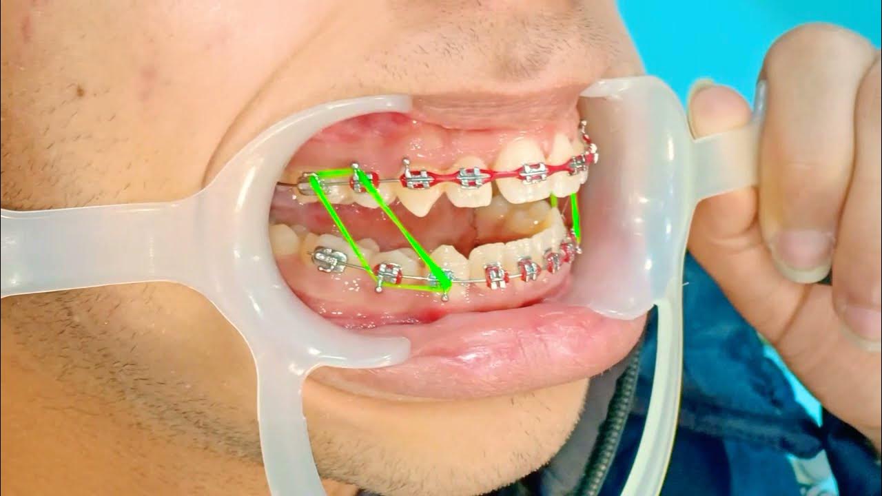 Braces finishing Class 3 settling Elastics مطاط تقويم الأسنان YouTube