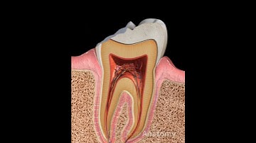 Broken cusp - pathology