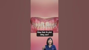Niềng răng thưa nào | Dr Anh Thư