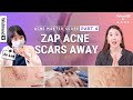 Acne Scar Treatment in Korea: Fraxel Lasers, Microneedling & Home Care TipsㅣPart4