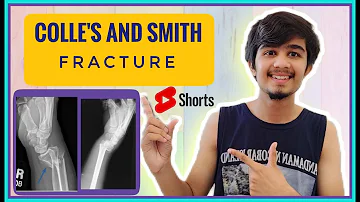 Colle's And Smith Fracture Diffrence | #shorts | Medico Darshil
