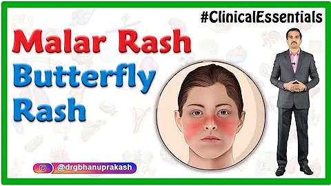Malar rash (Butterfly rash)  Dermatology : Clinica...
